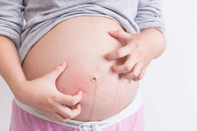 Bà bầu bị nổi mẩn đỏ ở bụng không ngứa là bị gì?