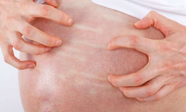 Các vết mẩn đỏ tập trung ở vùng bụng và có thể lan rộng ra xung quanh