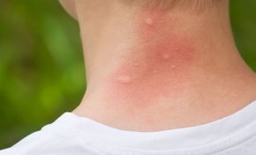 Lưu ý các biểu hiện da bị nổi mẩn đỏ ngứa nổi cục như muỗi đốt để xử lý kịp thời