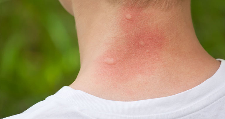 Lưu ý các biểu hiện da bị nổi mẩn đỏ ngứa nổi cục như muỗi đốt để xử lý kịp thời