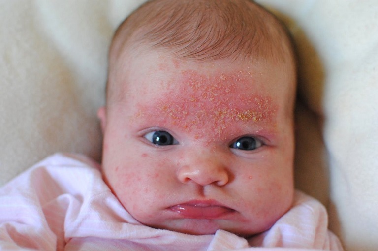 Trẻ sơ sinh bị viêm da cơ địa là tình trạng thường gặp