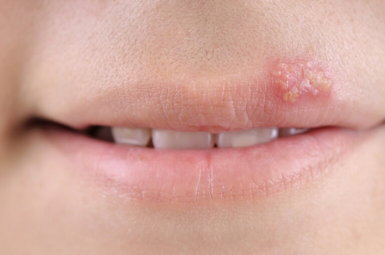 Bệnh chàm môi có lây không là câu hỏi thắc mắc của nhiều người bệnh hiện nay