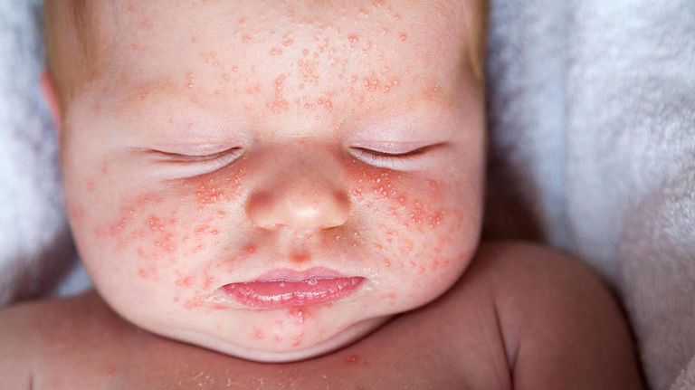 Bệnh chàm sữa là một căn bệnh phổ biến ở trẻ sơ sinh, gây tổn thương da của bé