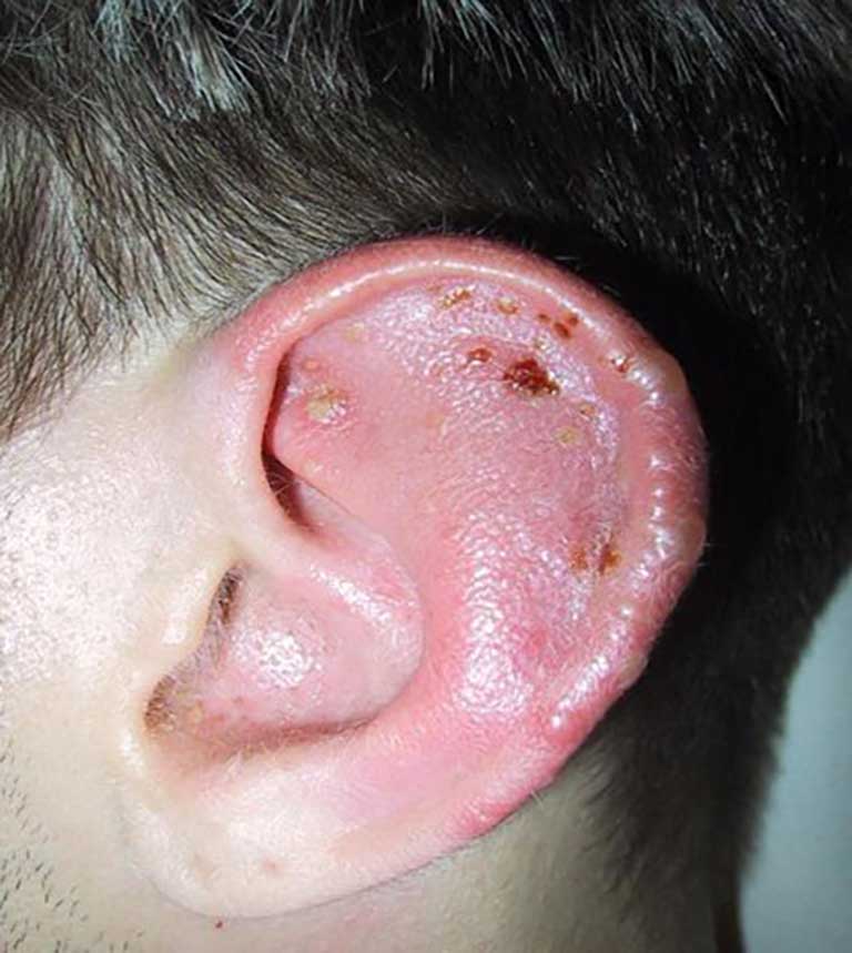 Biểu hiện bệnh chàm tai xuất hiện chủ yếu ở vành tai