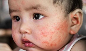 Bệnh eczema ở trẻ em xuất hiện khi lớp sừng Keratin không được ung cấp đủ lượng nước cần thiết