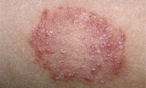 Mảng nấm da hình đồng xu là biểu hiện dễ nhận biết của bệnh
