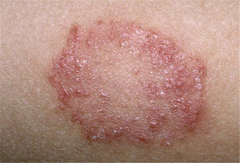 Mảng nấm da hình đồng xu là biểu hiện dễ nhận biết của bệnh