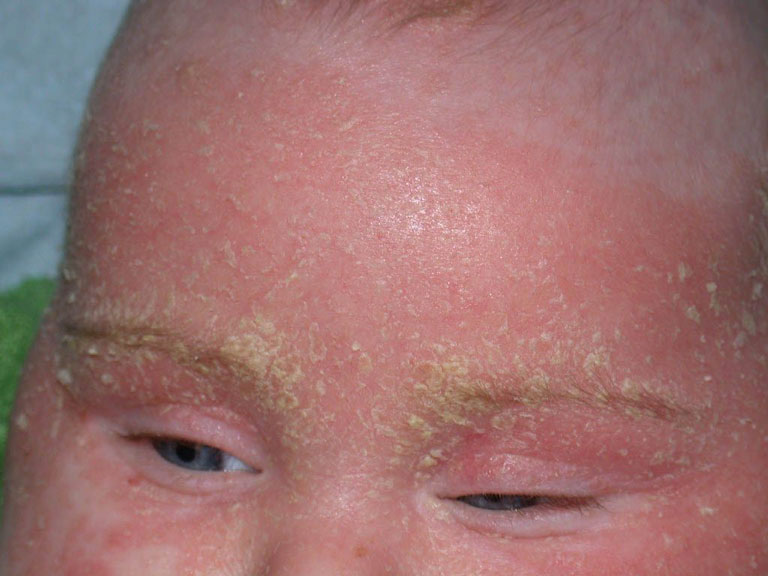 Bệnh vảy nến ở trẻ em là bệnh mã tính về da