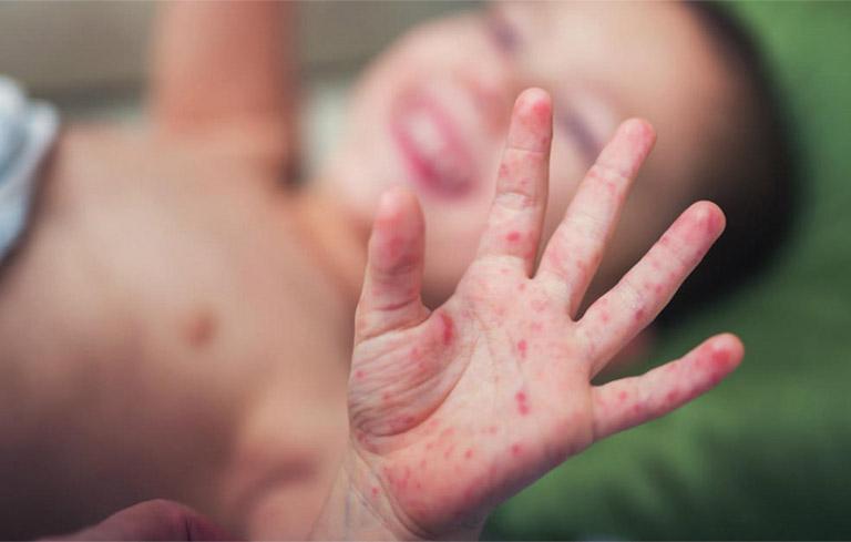 Da của trẻ bị tổn thương trên diện rộng nếu viêm da tiếp xúc không được điều trị nhanh chóng