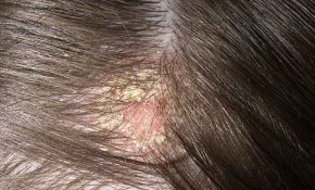 Cách trị nấm da đầu nhẹ tại nhà như thế nào hiệu quả?