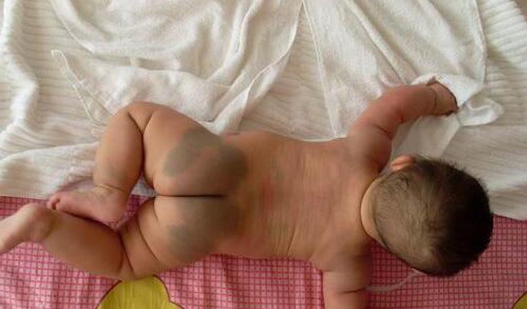 Chàm xanh ở trẻ sơ sinh