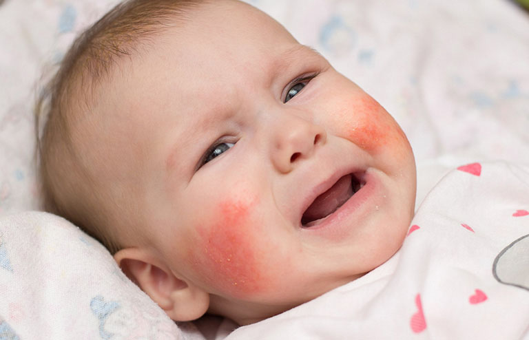 Trẻ sơ sinh 2-3 tháng tuổi thường xuyên mắc bệnh này