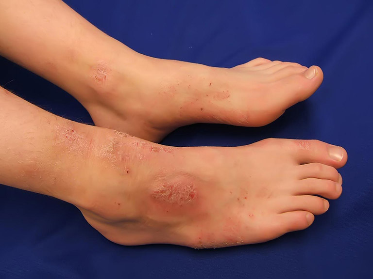 Thương tổn do chàm thể tạng thường xuất hiện ở chân tay