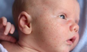 Chàm vành tai ở trẻ sơ sinh
