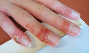 Bong tróc nghiêm trọng kèm chảy dịch mủ ngoài da là biểu hiện đặc trưng của bệnh