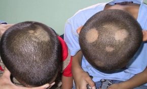 Nấm da đầu ở trẻ em: Nguyên nhân và cách điều trị hiệu quả