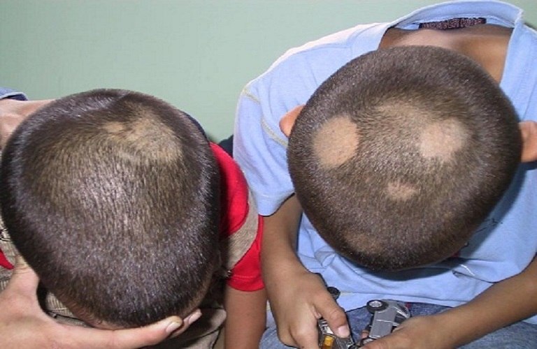 Trẻ bị nấm da đầu xuất hiện mảng tròn có vảy bong tróc kèm theo cảm giác ngứa ngáy
