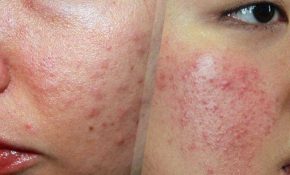 Dị ứng da mặt: Nguyên nhân và các cách trị nhanh nhất