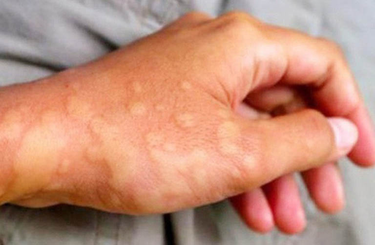 Nổi mề đay ngoài da là biểu hiện đặc trưng của bệnh