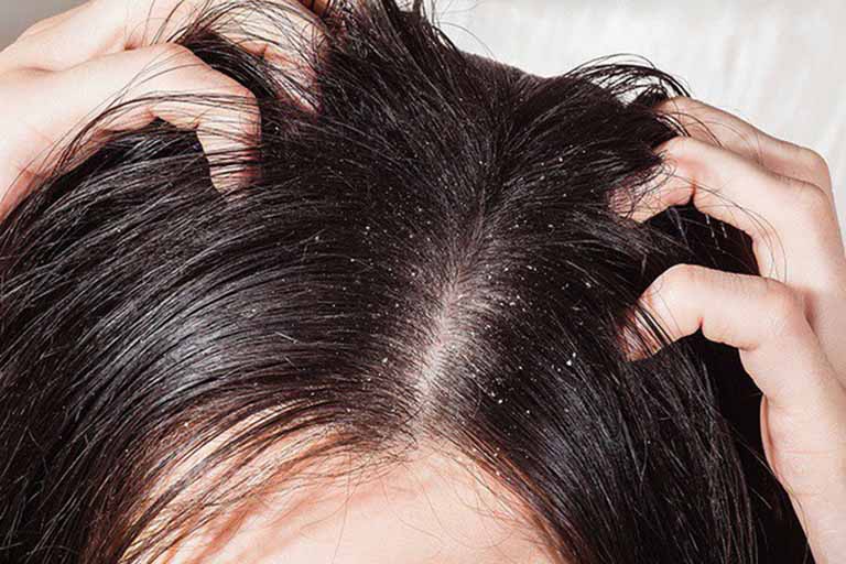 Bia trị nấm da đầu có hiệu quả tùy theo giai đoạn và tình trạng bệnh của mỗi người