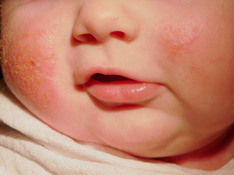 Triệu chứng của hắc lào là xuất hiện các nốt đỏ có mụn mủ trên da của bé