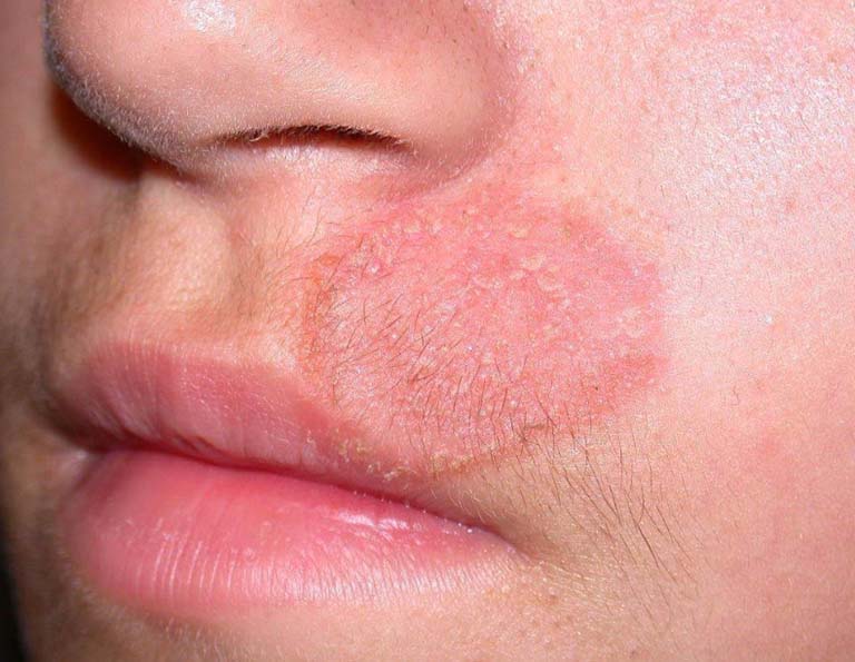 Bệnh hắc lào ở mặt nghiêm trọng hơn các vùng da khác trên cơ thể 