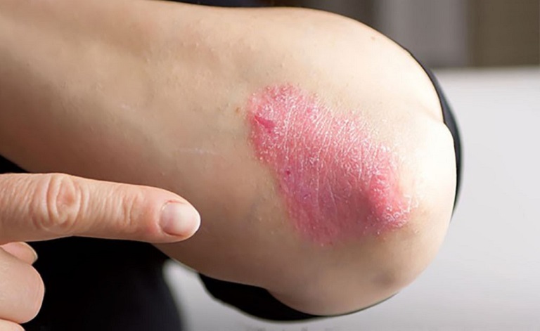 Hắc lào ở tay, chân là hiện tượng thường gặp do nấm gây ra