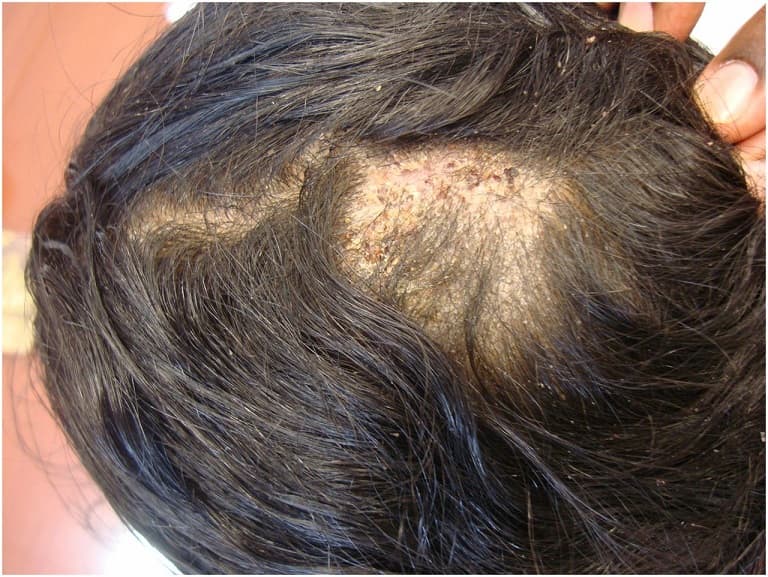 Nấm da đầu ở mức độ nặng có rụng tóc thành mảng lớn và mưng mủ