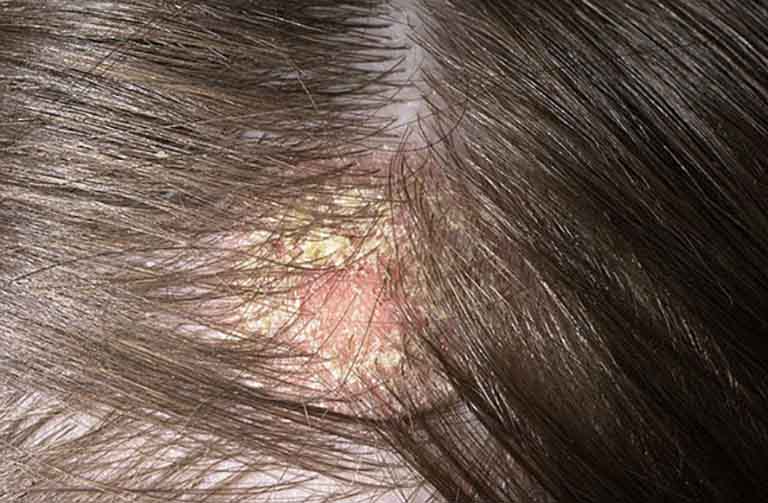Nấm da đầu nặng gây ảnh hưởng nghiêm trọng tới thẩm mỹ và sức khỏe