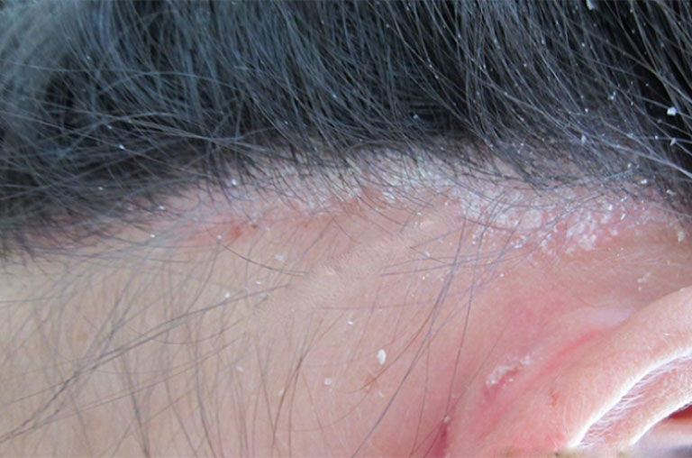Nấm da đầu có lây lan xuống mặt và nhiều bộ phận khác