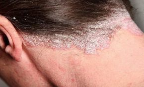 Bệnh nấm da đầu có lây không? 