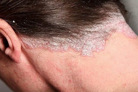 Bệnh nấm da đầu có lây không? 
