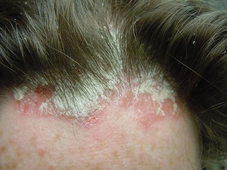 Hình ảnh bệnh nấm da đầu nặng do không được điều trị kịp thời và đúng cách