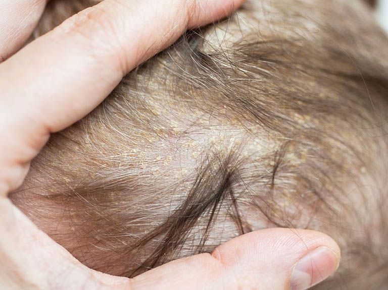 Nấm da đầu là nỗi lo lắng của nhiều bậc phụ huynh