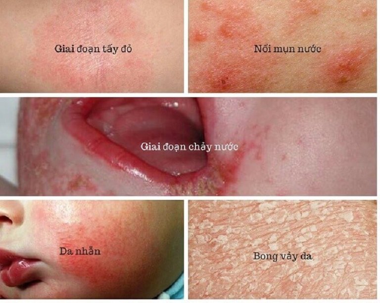 Các giai đoạn phát triển của chàm eczema