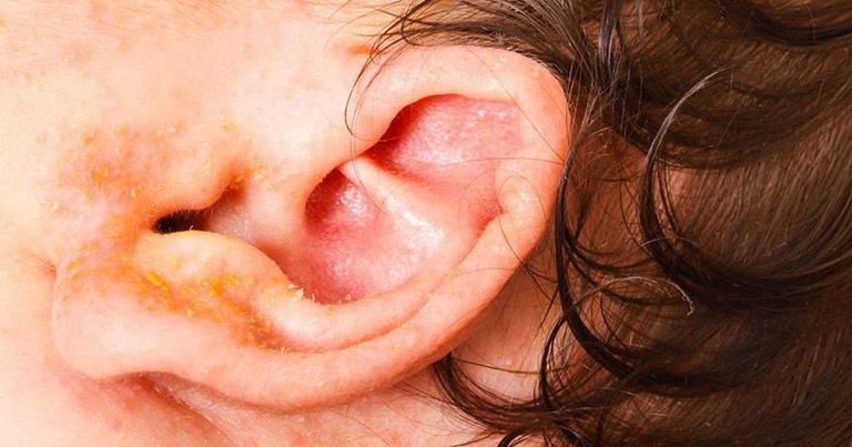 Chàm vành tai ở trẻ sơ sinh gây ngứa và chảy mủ vàng