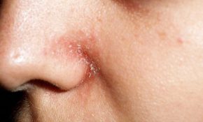 Bệnh khiến người bệnh khó chịu, sưng, bong tróc trên bề mặt da