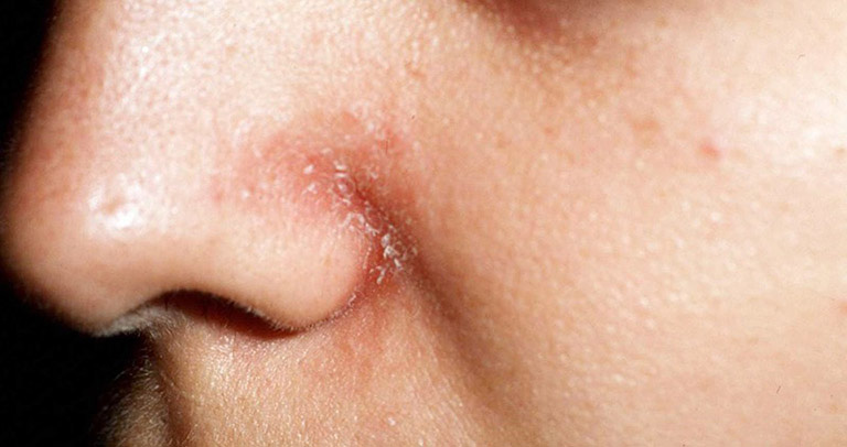 Bệnh khiến người bệnh khó chịu, sưng, bong tróc trên bề mặt da