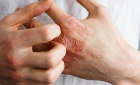 Viêm da tiếp xúc bội nhiễm là tình trạng nặng của bệnh viêm da thông thường