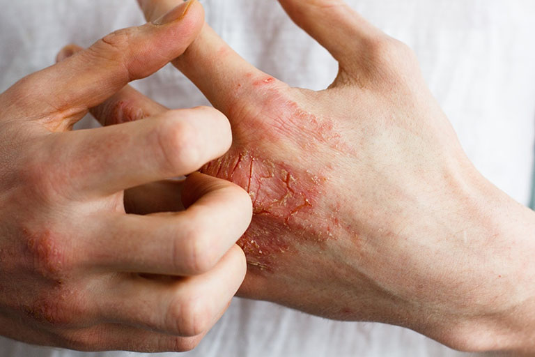 Viêm da tiếp xúc bội nhiễm là tình trạng nặng của bệnh viêm da thông thường
