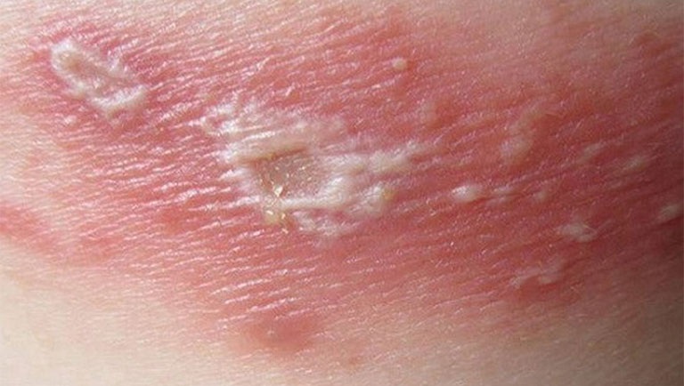 Các vết tổn thương sâu ở da có thể để lại sẹo thâm