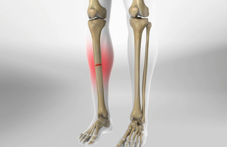 Gãy xương sẽ xảy ra khi có va chạm mạnh dẫn tới chấn thương gây khó cử động hay đi lại