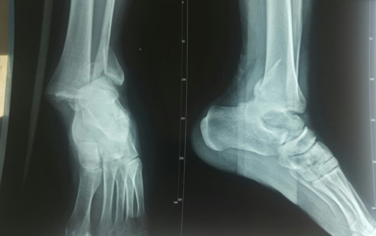 Hình ảnh X-quang chụp dây chằng cổ chân