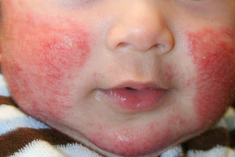 Bệnh chàm thường xuất hiện ở đối tượng trẻ em