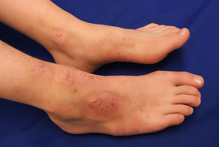 Bệnh chàm ở chân là một căn bệnh da liễu gây ra nhiều triệu chứng khó chịu cho người bệnh