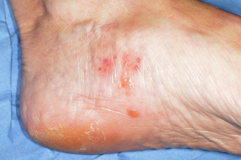 Chàm eczema không phải là một căn bệnh da liễu nguy hiểm