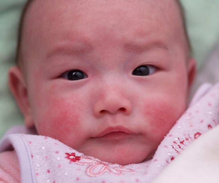 Vết chàm đỏ ở trẻ sơ sinh cũng rất dễ bị nhầm lẫn với bớt nevi giãn mao mạch