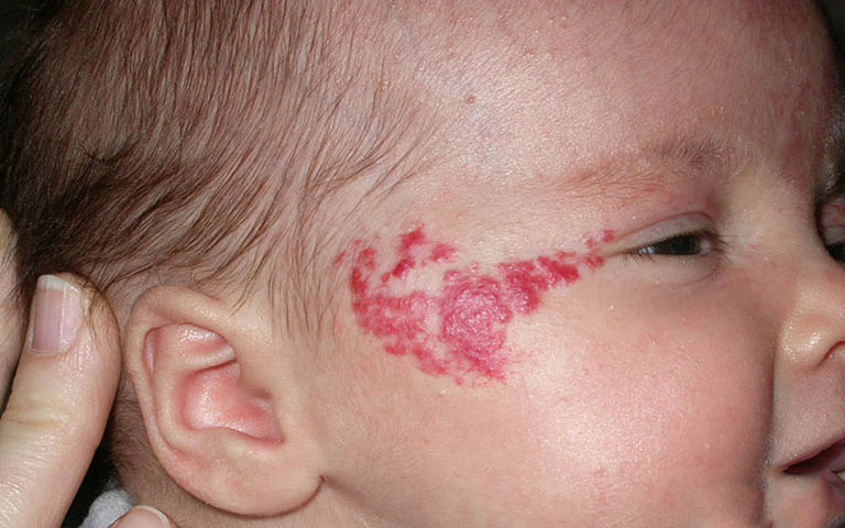 Chàm đỏ ở trẻ sơ sinh là một hiện tượng giãn mao mạch