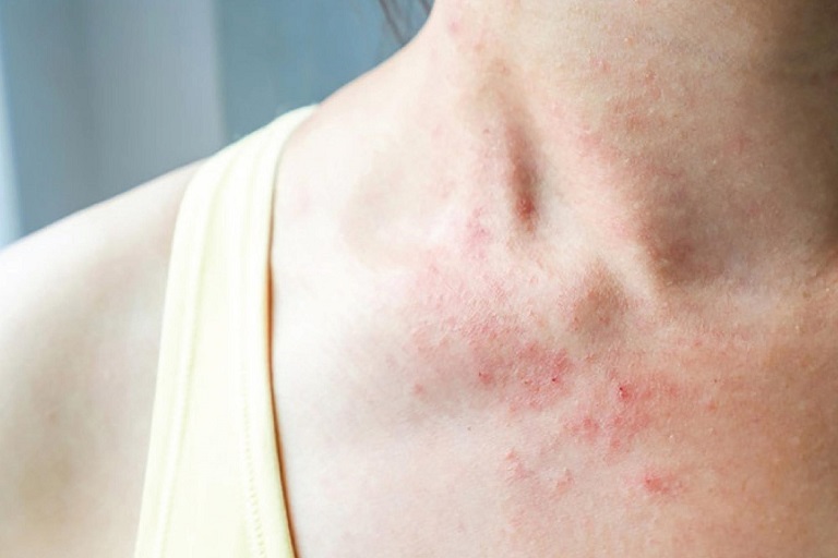 Triệu chứng của bệnh chàm khô xuất hiện khá rõ ràng trên da
