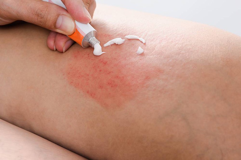 Các loại thuốc bôi da được sử dụng phổ biến trong điều trị bệnh chàm khô